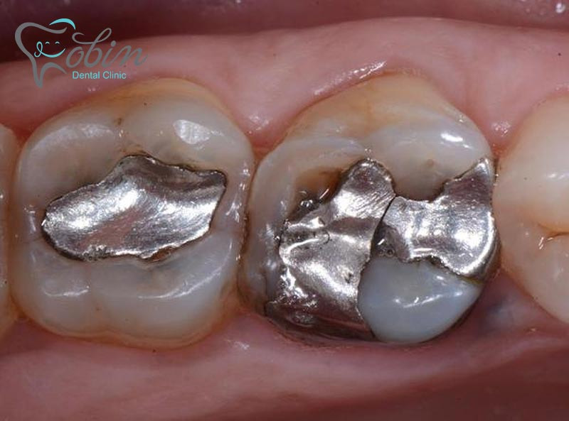 استفاده از فلزات در ترمیم دندان
